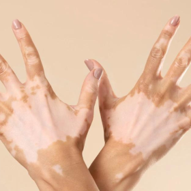 vitiligo_image_2