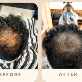 exosome for hair loss